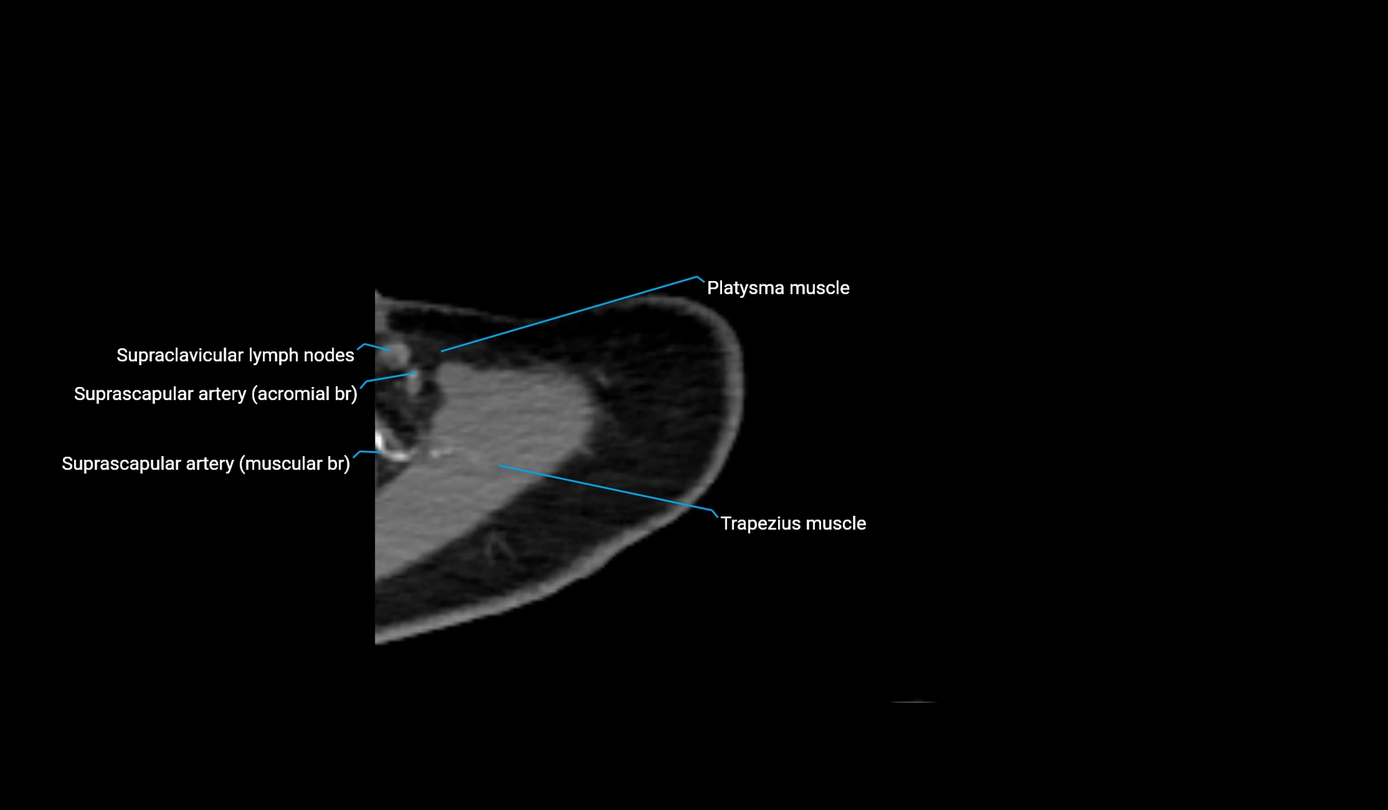 CT upper arm axial  cross sectional anatomy labelled radiology image -00044.webp